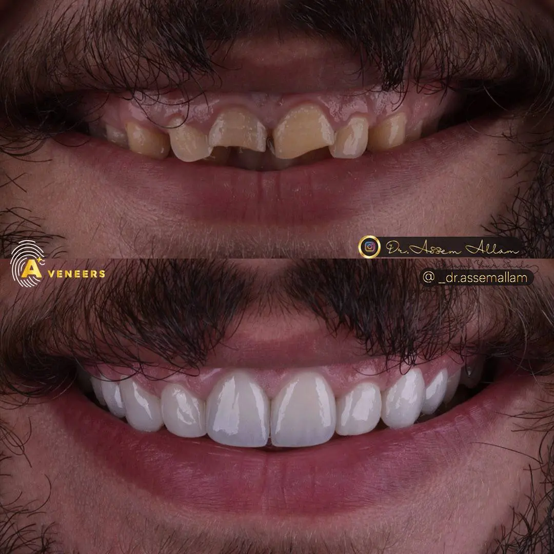 Mohamed J Smile Before and After